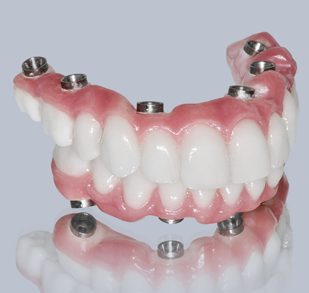Dental implant prosthodontics at Geach Dental