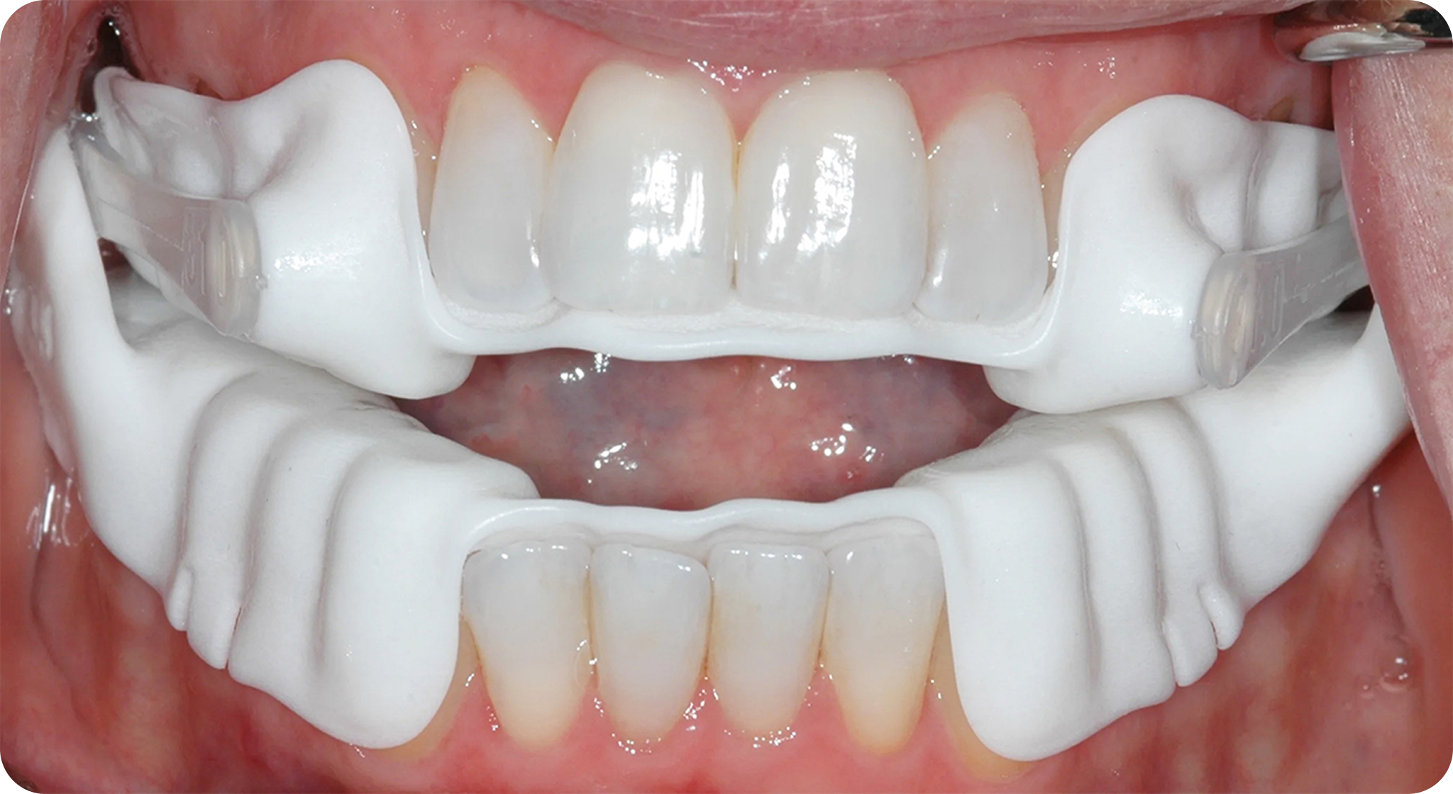 Our Sleep Apnea Treatment Process - Dr. Adam Geach Dental Practitioner