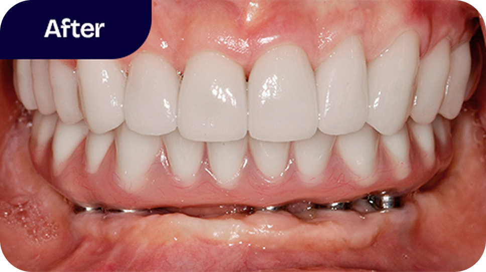 Full mouth reconstruction after