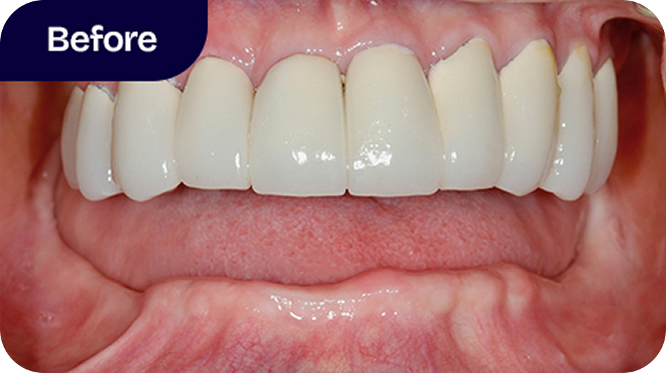 Full mouth reconstruction before