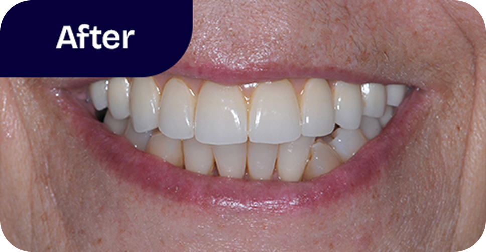 Upper teeth All-on-4 implant bridge after