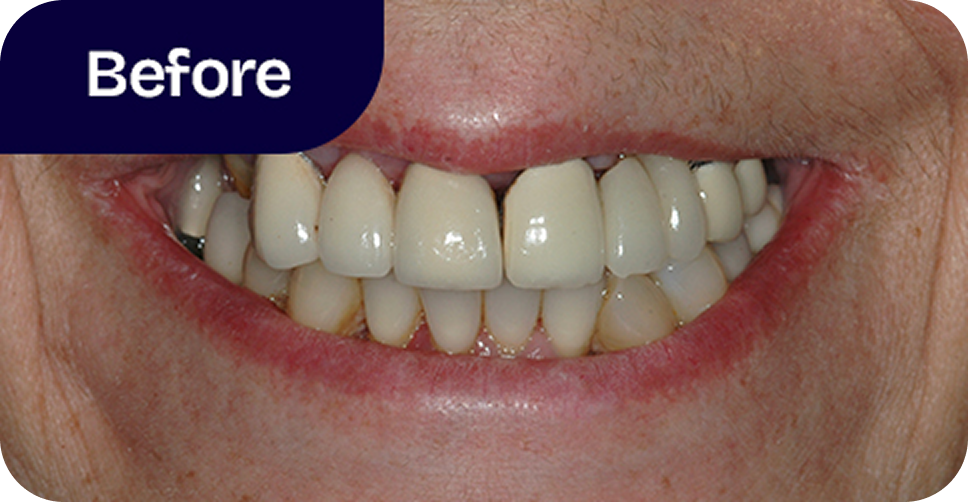 Upper teeth All-on-4 implant bridge before