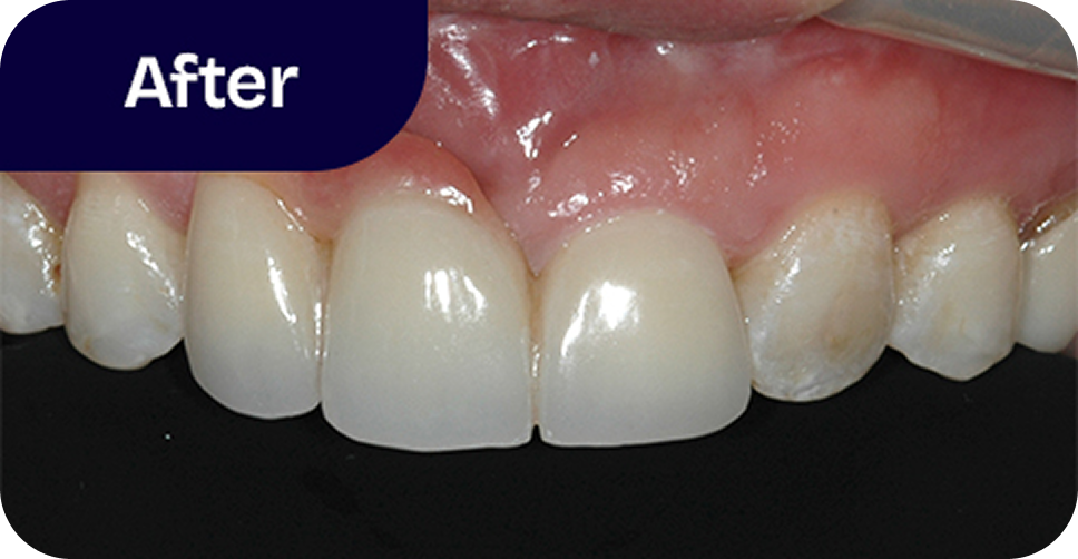 Cleft lip and palate replacement after