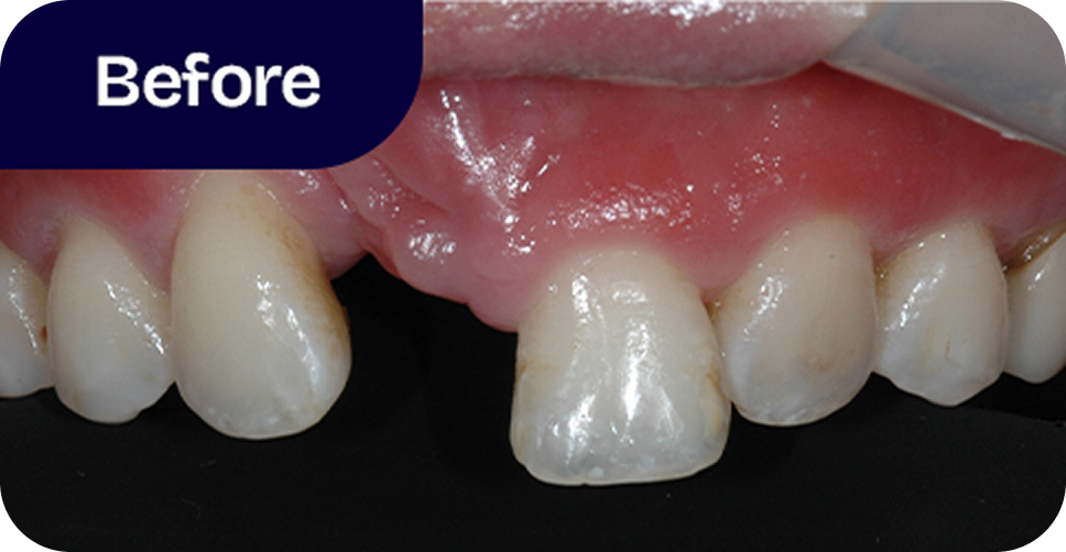 Cleft lip and palate replacement before
