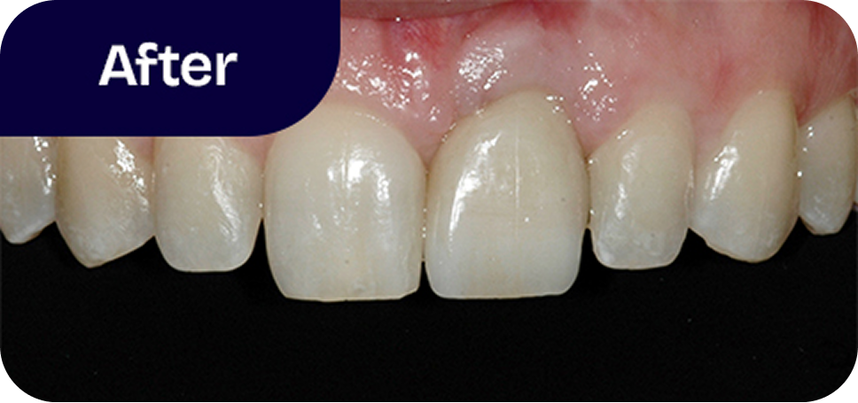 Dental implant and ceramic crown after
