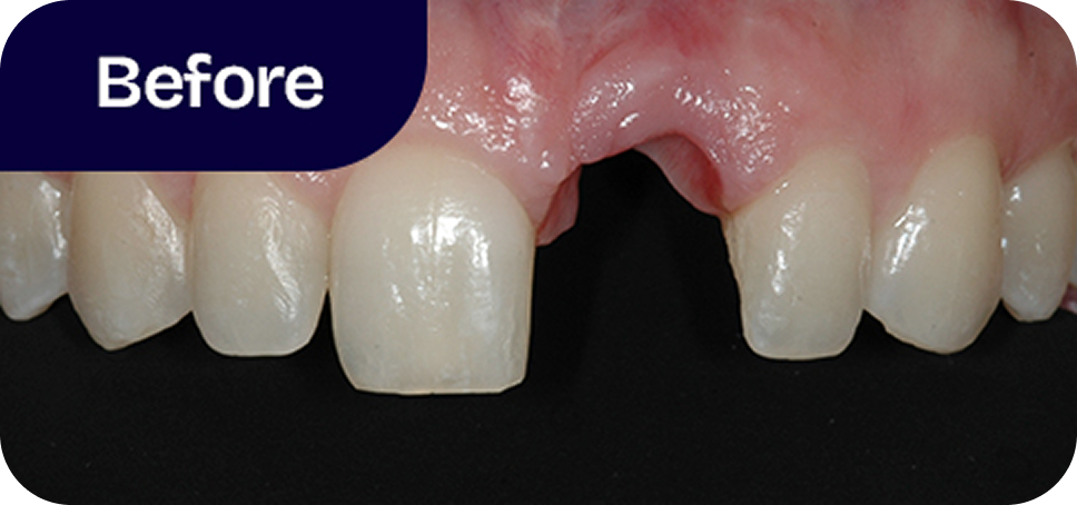 Dental implant and ceramic crown before