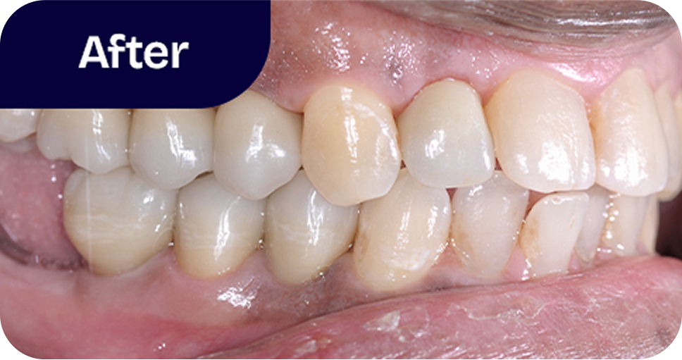 Implants and ceramic crowns after