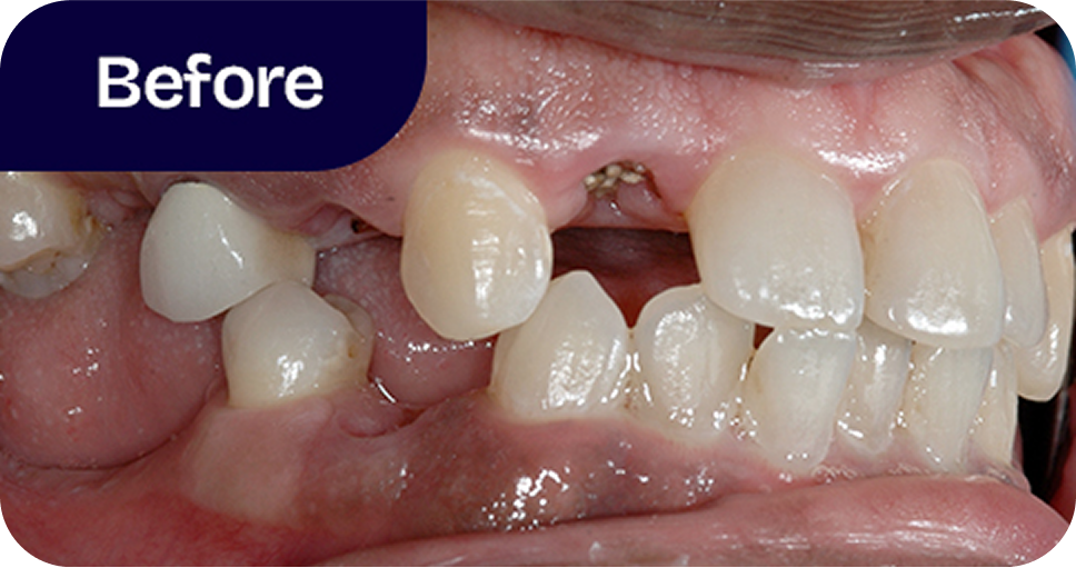 Implants and ceramic crowns before