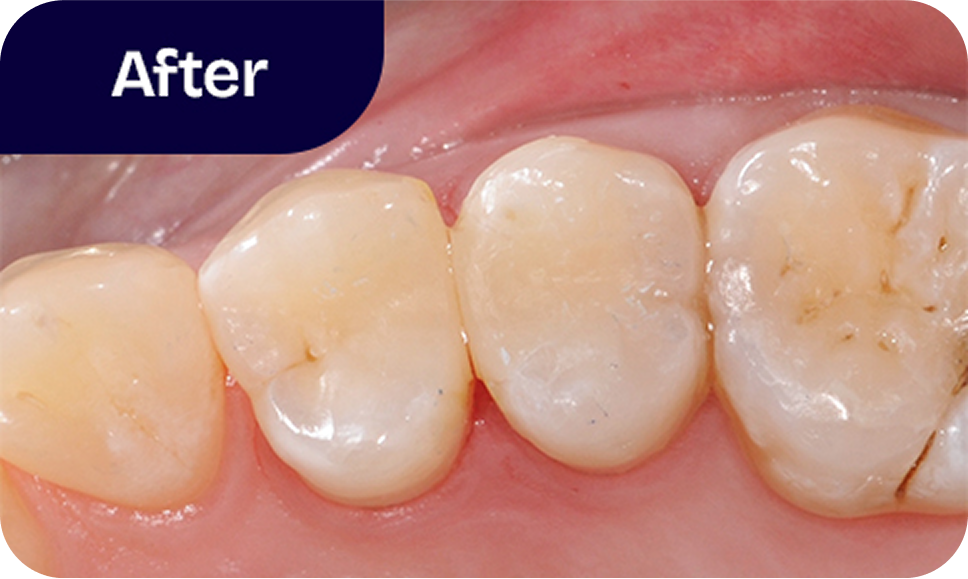 Tooth-colored fillings after