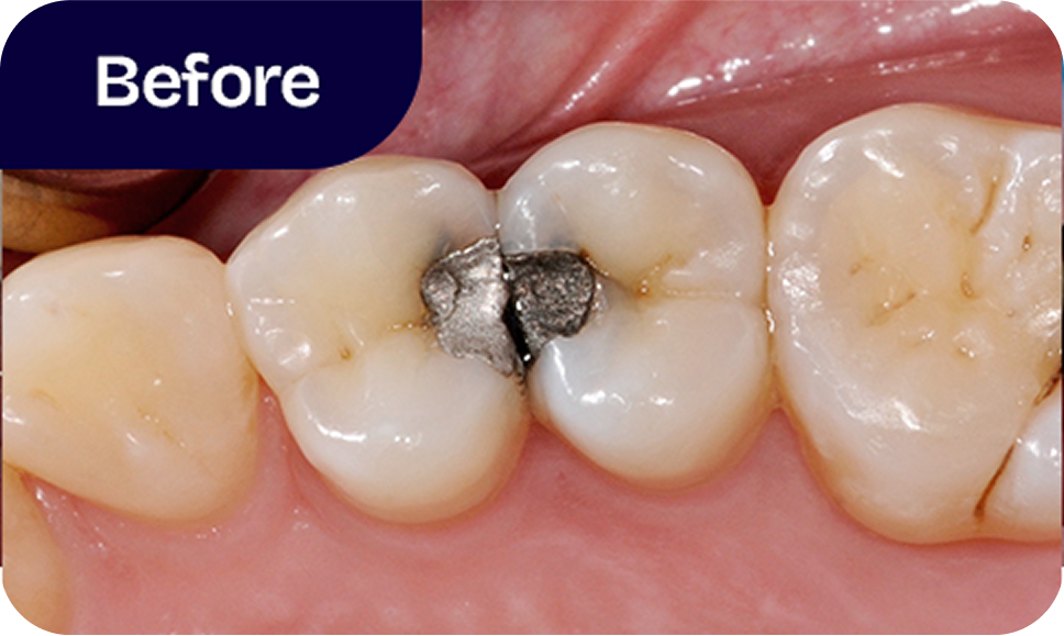 Old silver fillings before