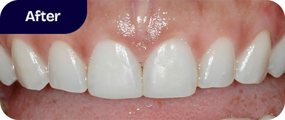 Cosmetic bonding chipped teeth after