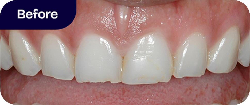 Cosmetic bonding chipped teeth before