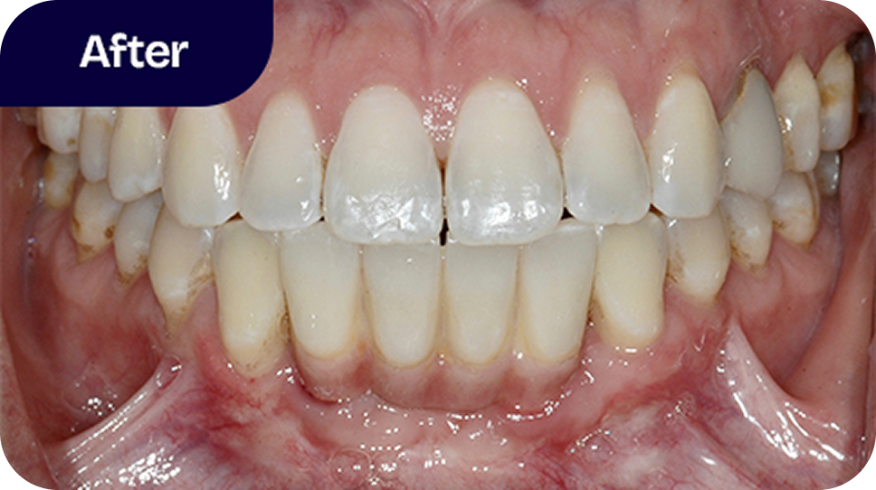 4-tooth permanent bridge after