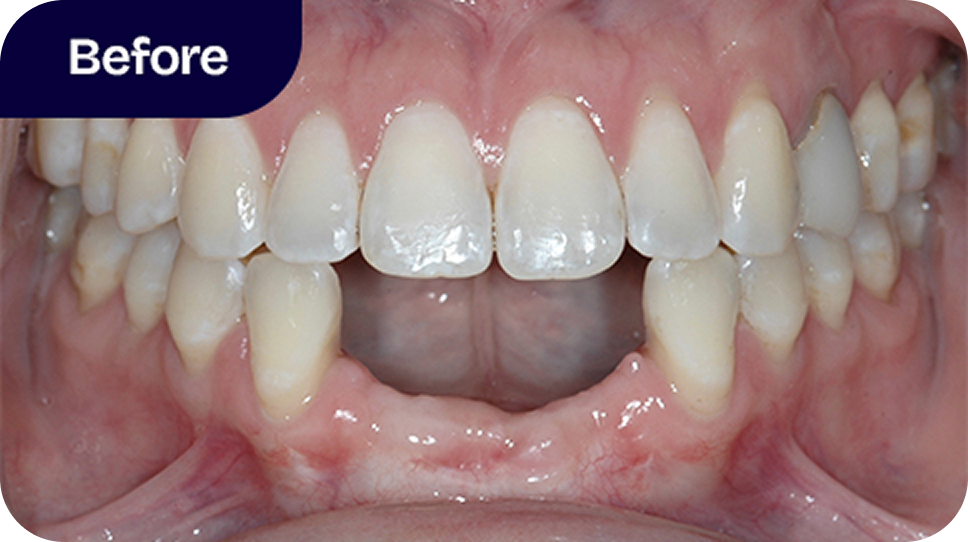 4-tooth permanent bridge before