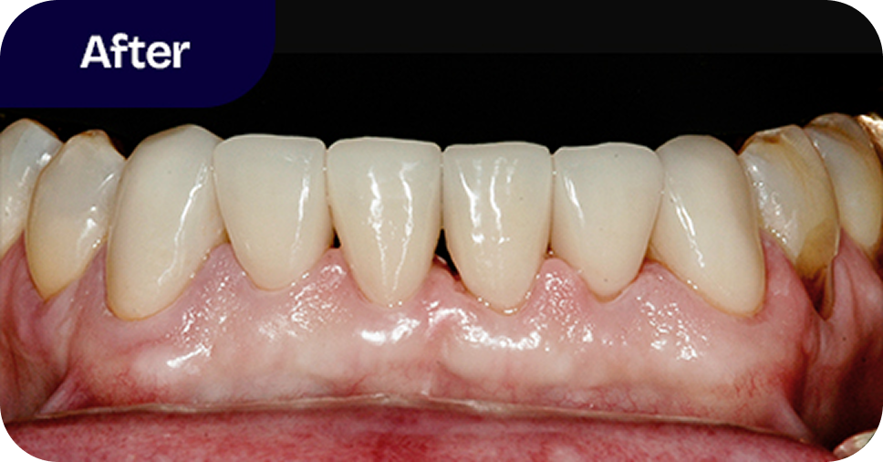 Lower incisors restored with ceramic crowns after