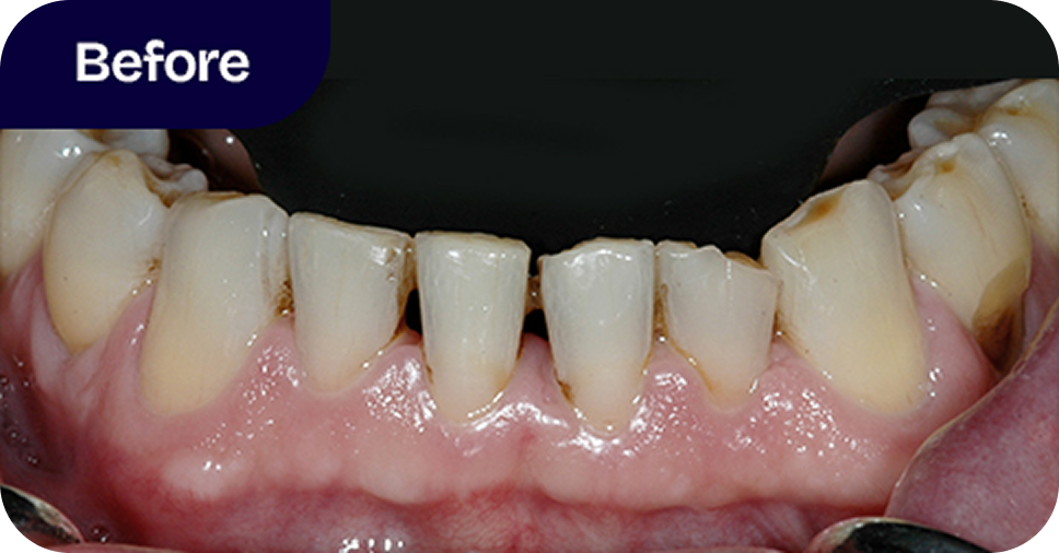 Lower incisors restored with ceramic crowns before
