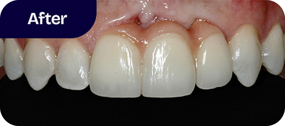 Missing tooth replaced with permanent ceramic bridge after