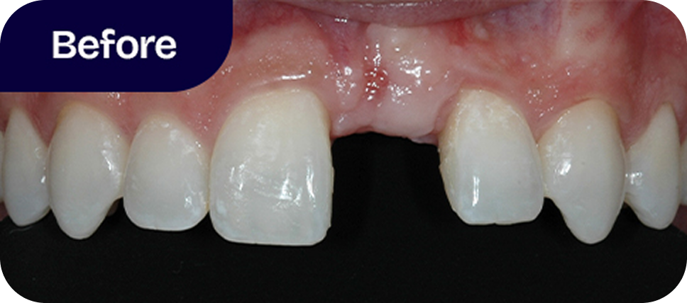 Missing tooth replaced with permanent ceramic bridge before
