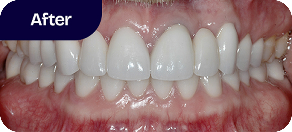 Complete smile makeover after