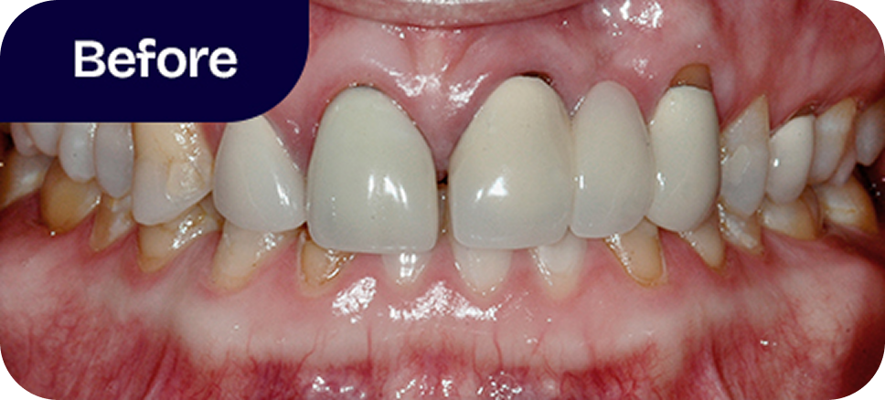 Complete smile makeover before
