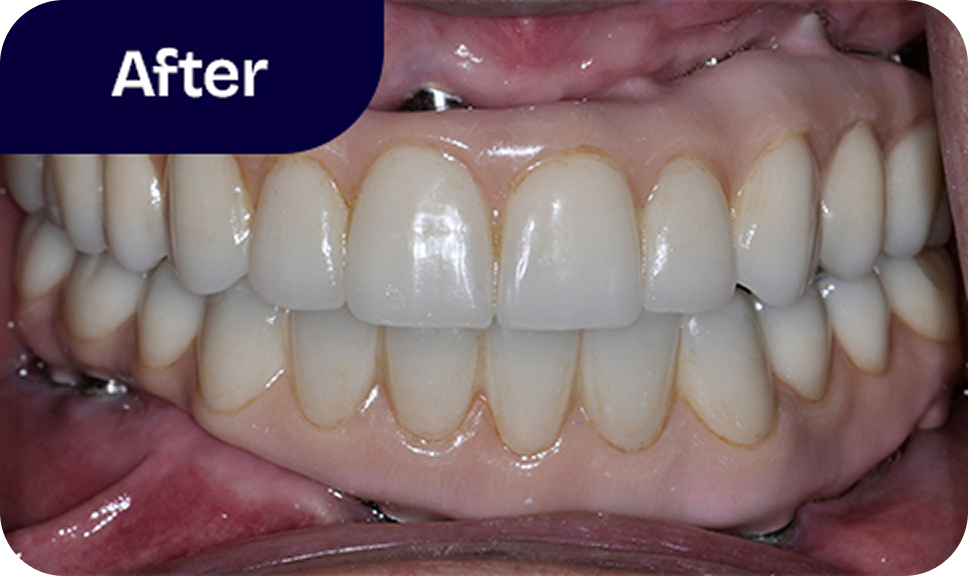 Full-mouth reconstruction All-on-4 after