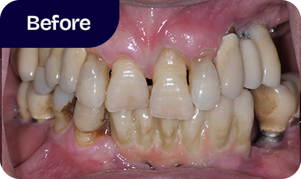 Full-mouth reconstruction All-on-4 before