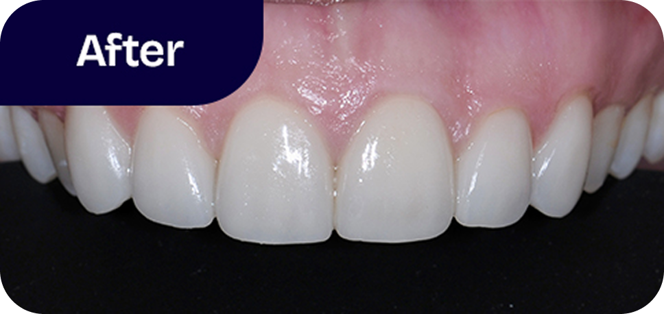 Veneers upper front teeth after