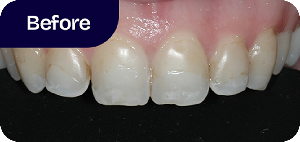 Veneers upper front teeth before