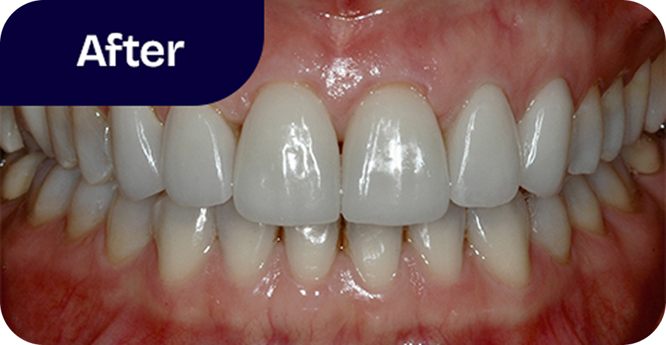 Veneers upper and lower teeth after