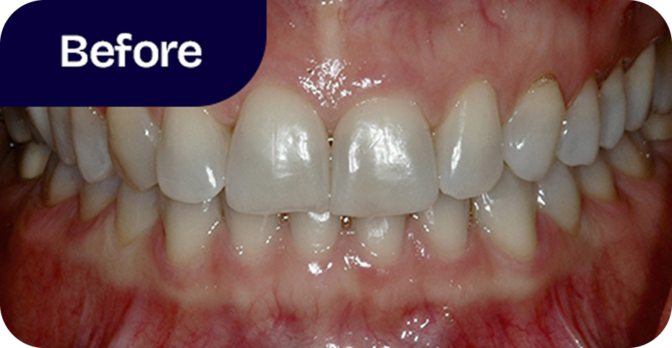 Veneers upper and lower teeth before