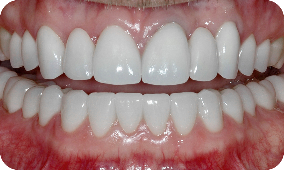 Front view of a smile - are you a good candidate for smile makeover
