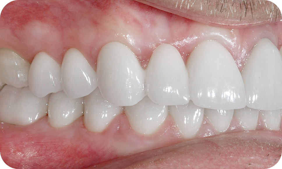 Profile view of a smile - are you a good candidate for smile makeover
