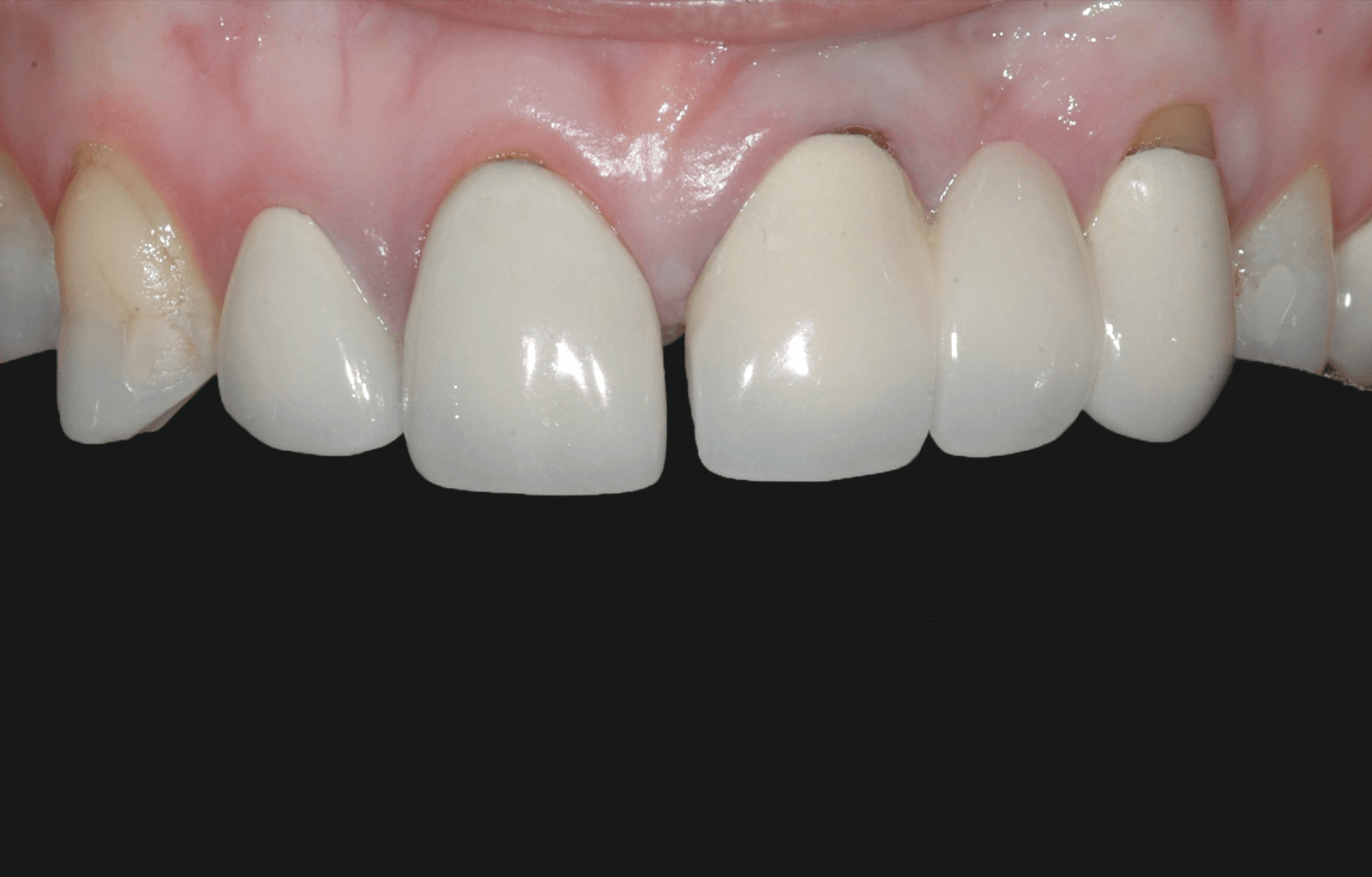 Crooked teeth - smile makeover at Geach Dental