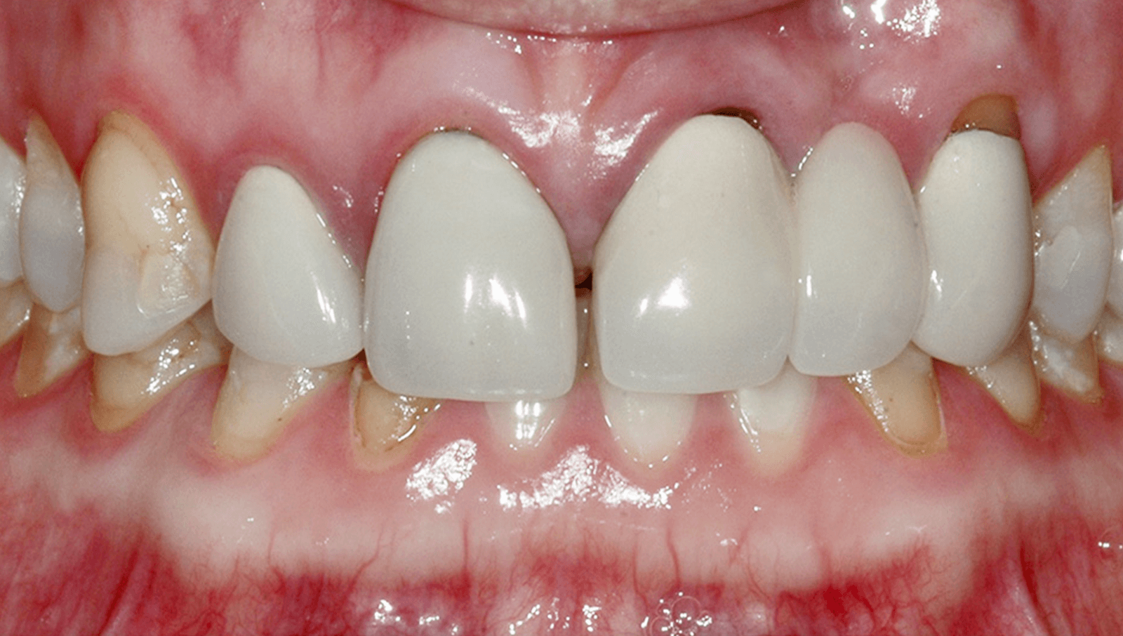 Stains and discoloration - smile makeover at Geach Dental