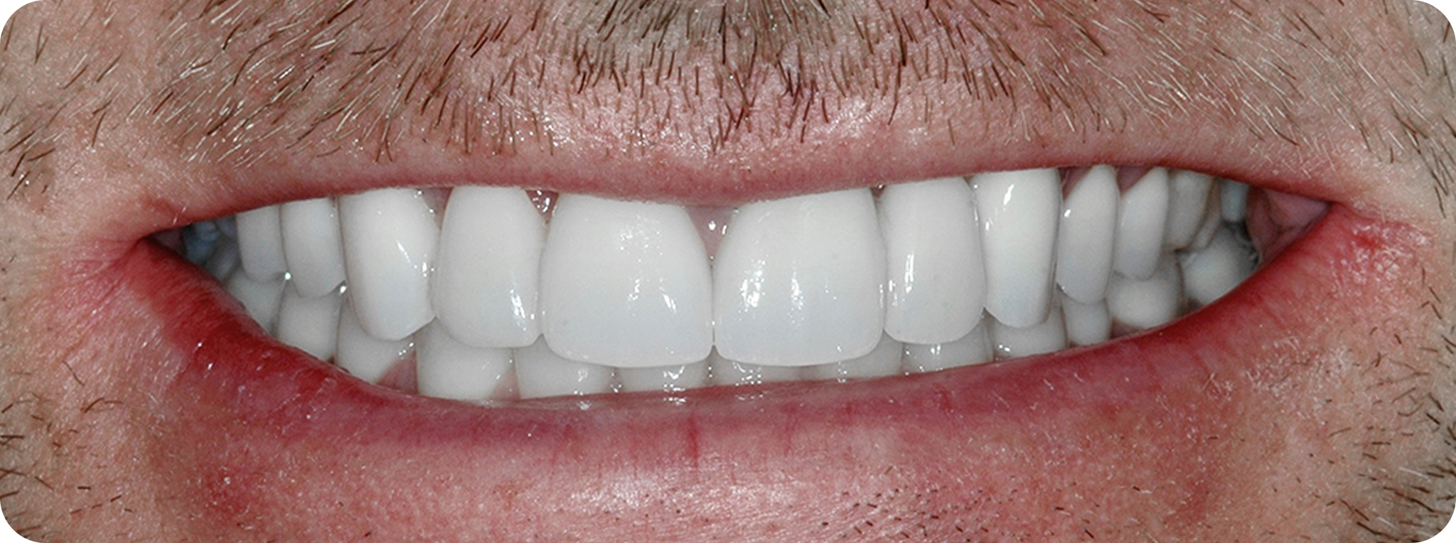 The smile makeover process - Dr. Adam Geach