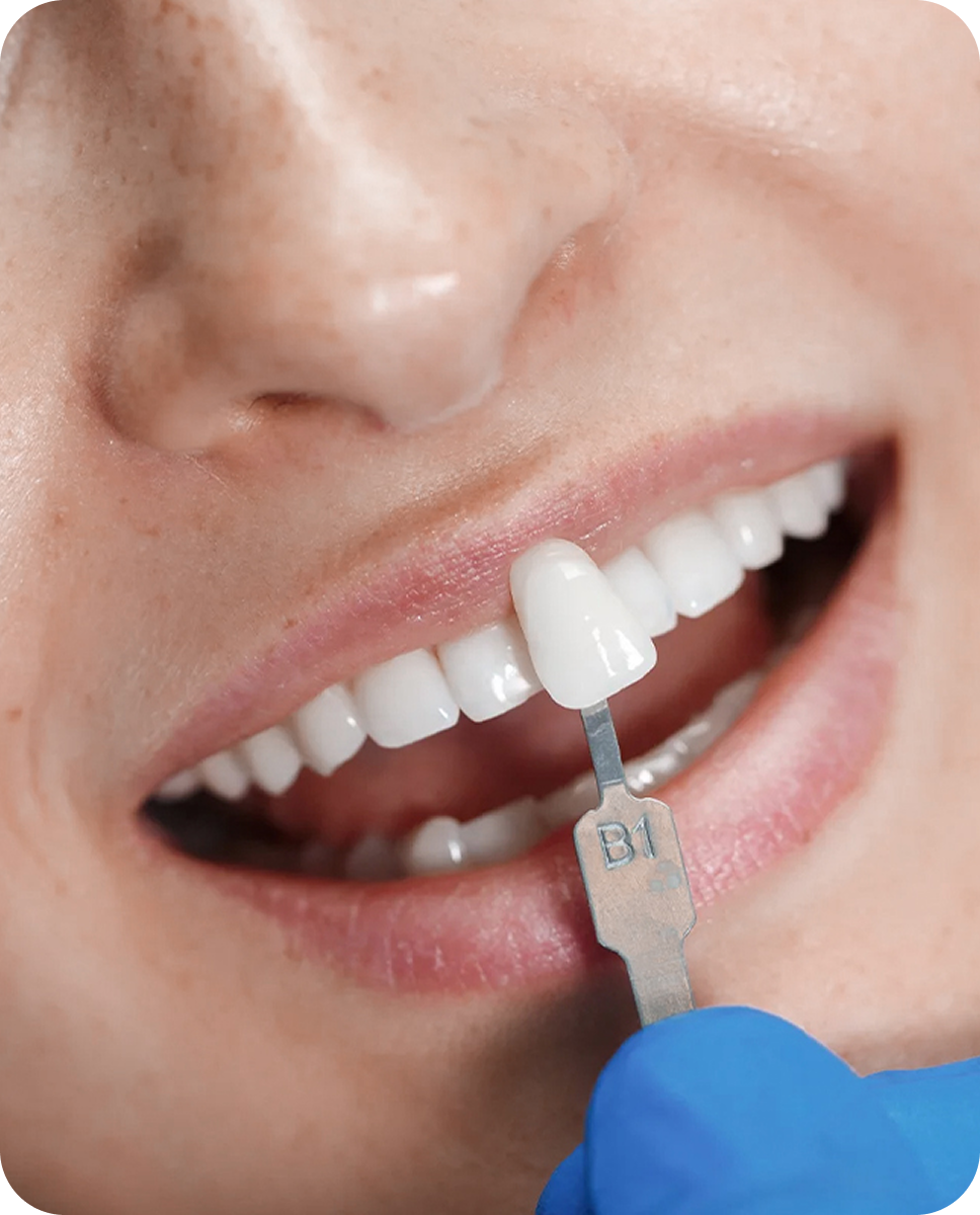 White smile result after tooth-colored fillings