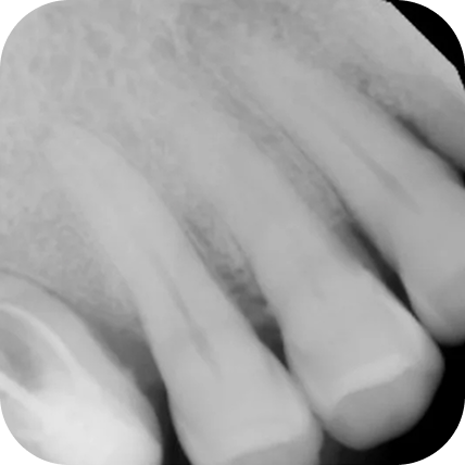 X-ray of a tooth needing to be extracted 1