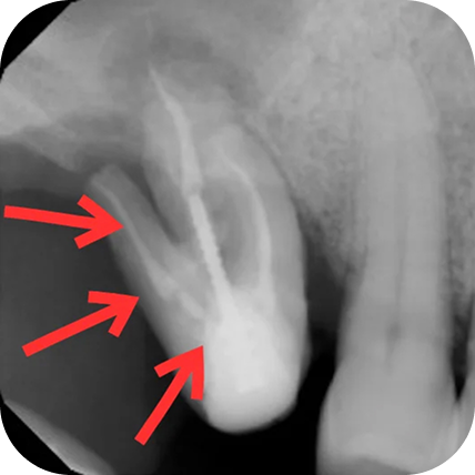 X-ray of a tooth needing to be extracted 2
