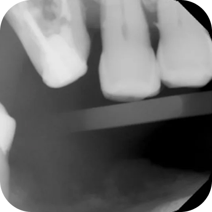 X-ray of a tooth needing to be extracted 3