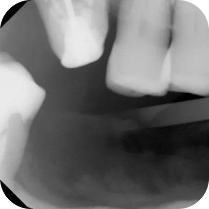 X-ray of a tooth needing to be extracted 4