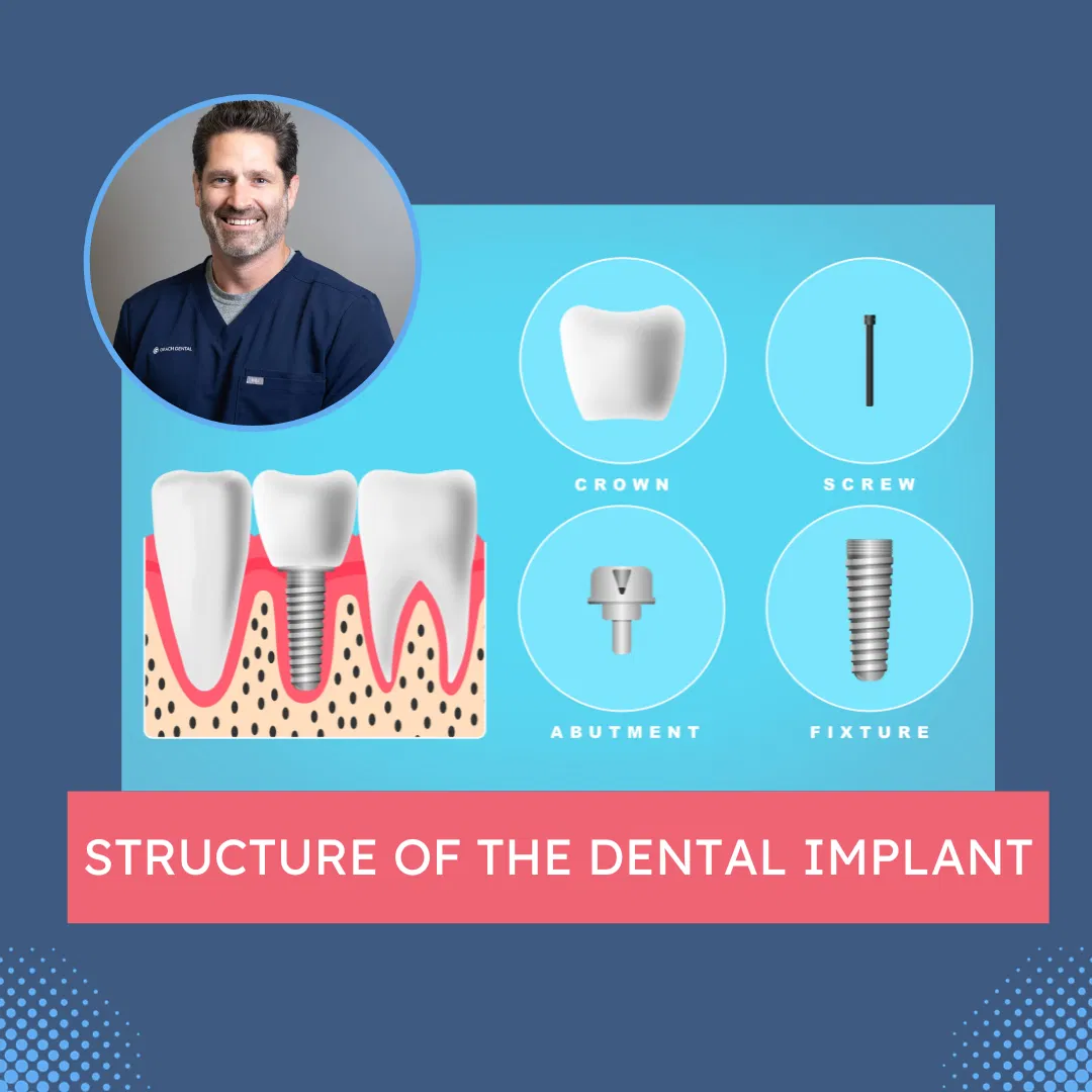 How Successful is Dental Implant Treatment?