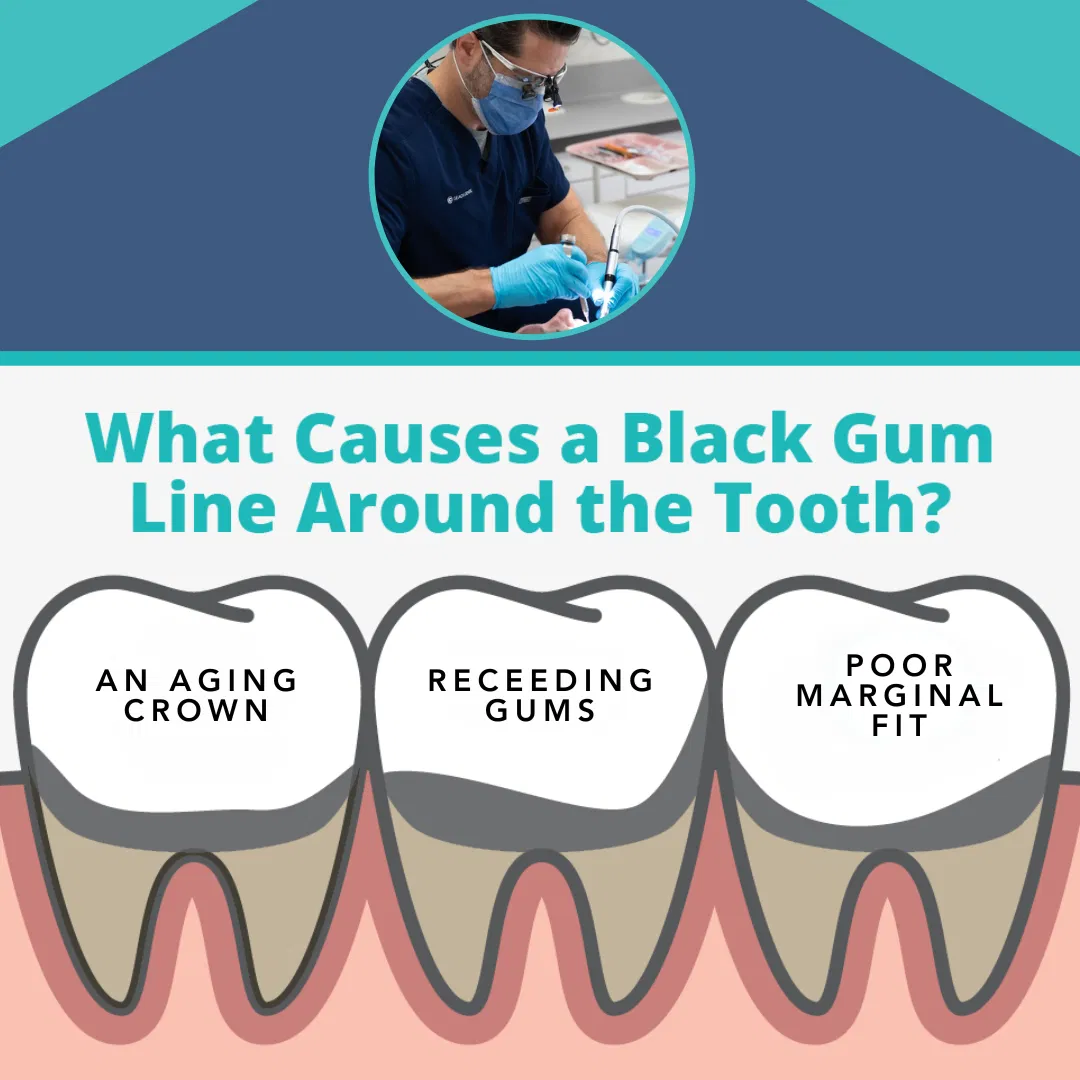 Correcting The Black Border At The Gumline Of Crowns – Before And After