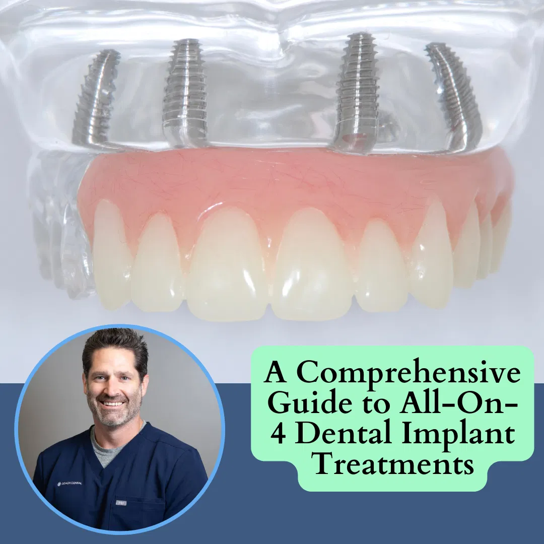 The Basics of All-On-4-Dental Implant Treatments