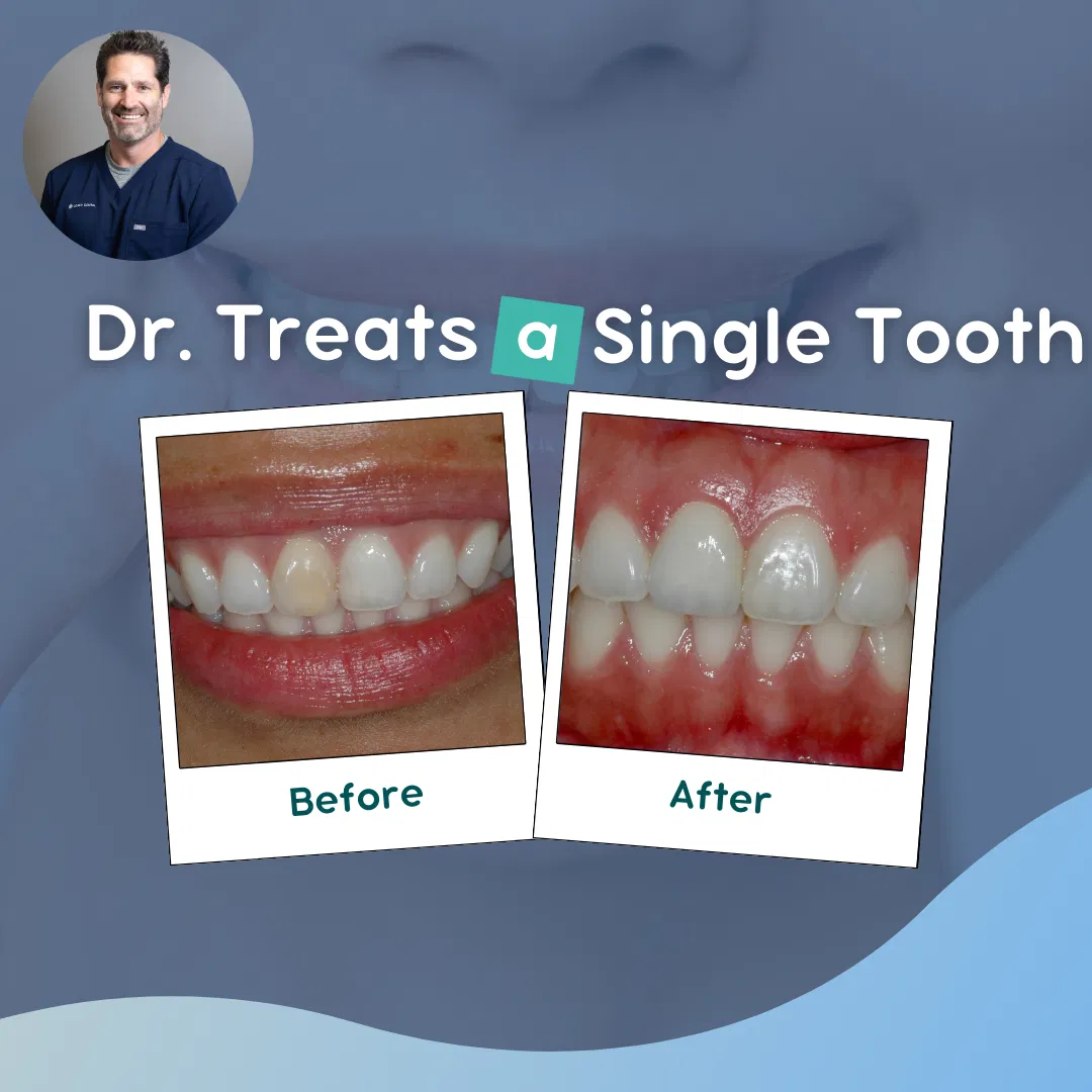 How A Los Angeles Prosthodontist Cosmetically Treats A Single Tooth