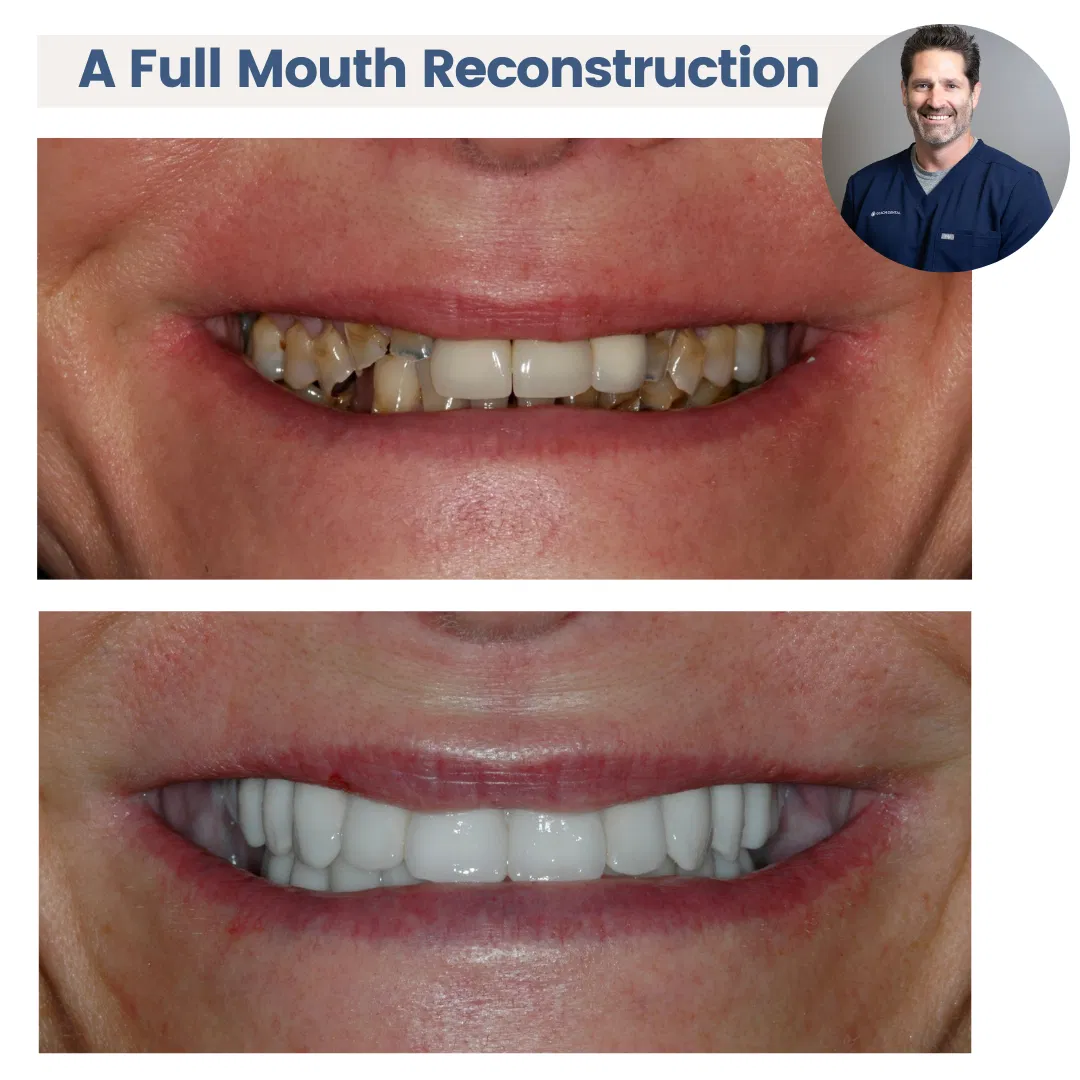 A Full-Mouth Reconstruction To Replace Decayed and Broken Teeth