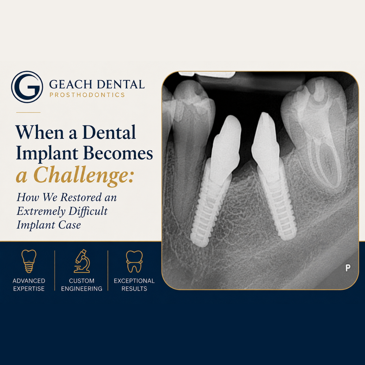 When a Dental Implant Becomes a Challenge: How We Restored an Extremely Difficult Implant Case