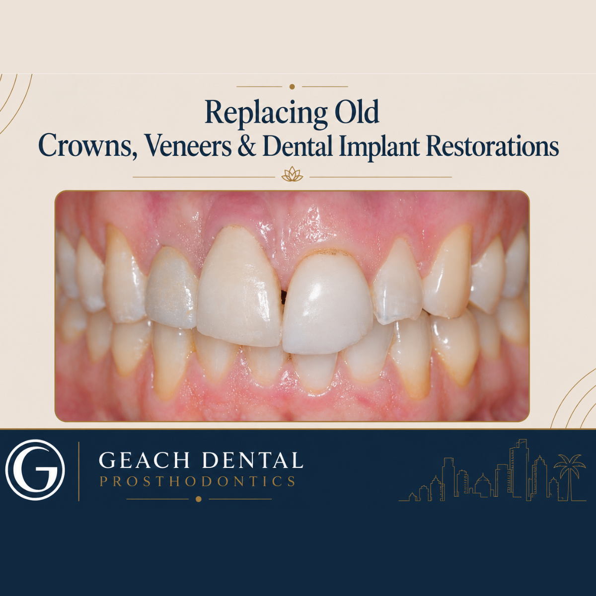 Replacing Old Crowns, Veneers and Dental Implant Restorations for a Natural, Younger Smile