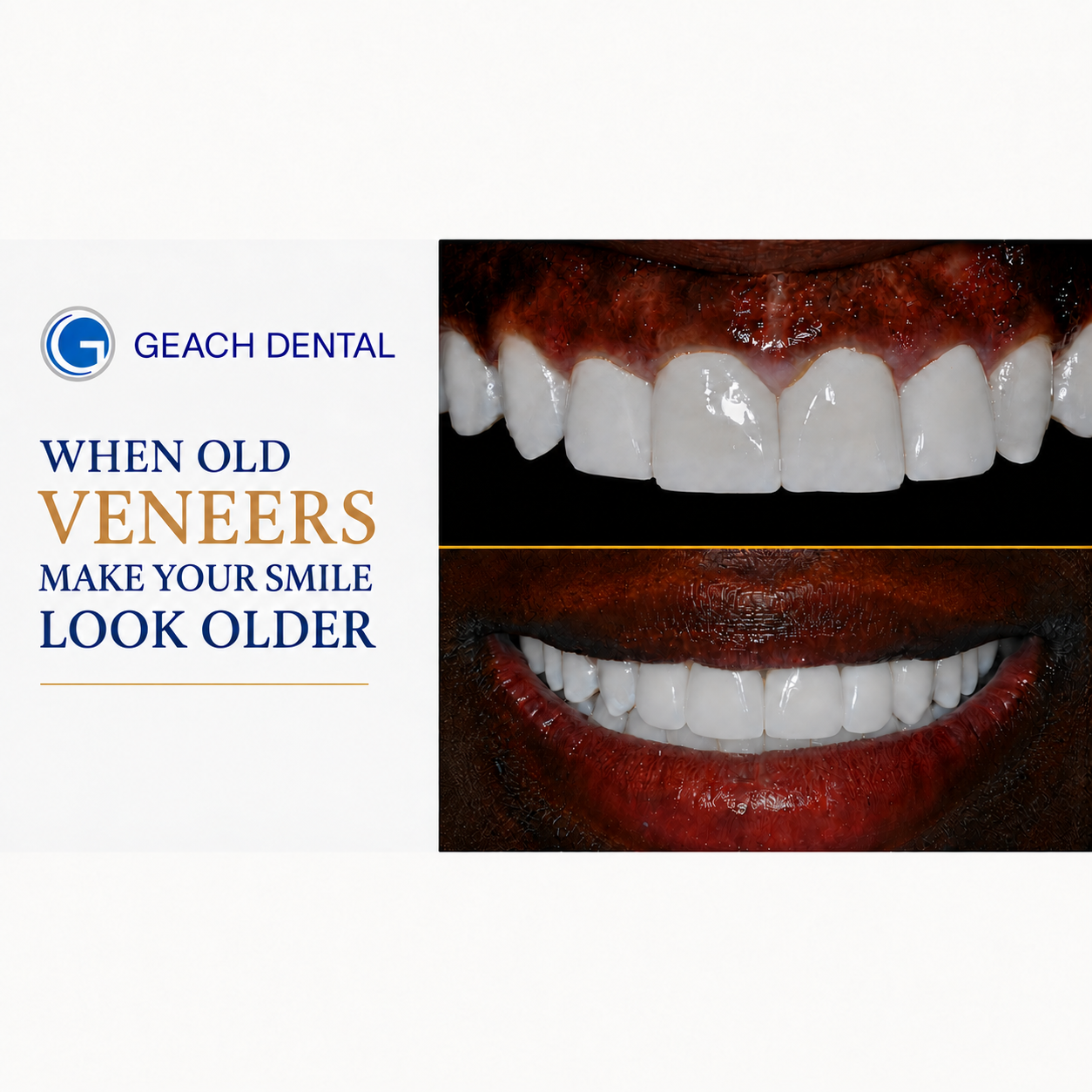 When Old Veneers Make Your Smile Look Older