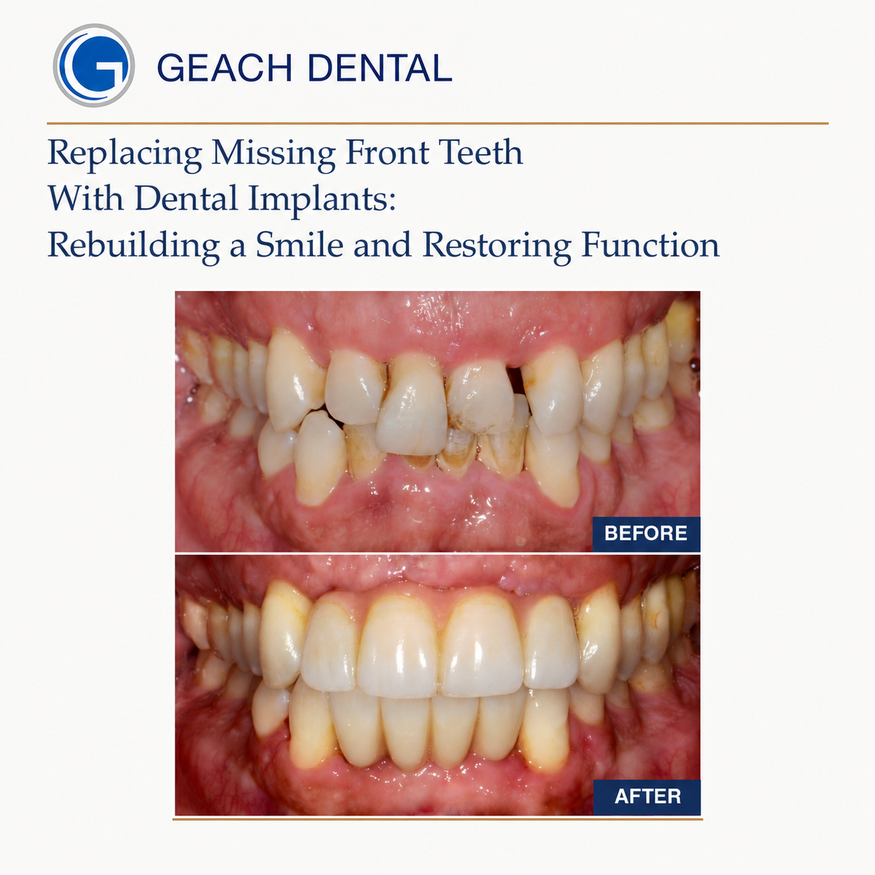 Replacing missing front teeth with dental implants